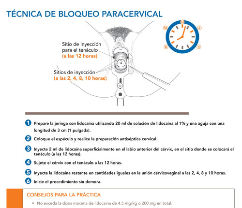Técnica de bloqueo paracervical