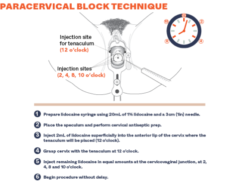Paracervical Injection Paracervical Block Technique - Ipas