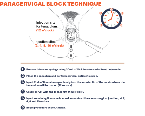 Paracervical Block Technique