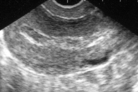 Black and white ultrasound image showing layered tissues with a curved, dark area near the center, indicating internal anatomy, possibly the abdomen.