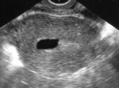 Black and white ultrasound image showing a round gestational sac with a small, dark, elongated area inside, indicating an early pregnancy.